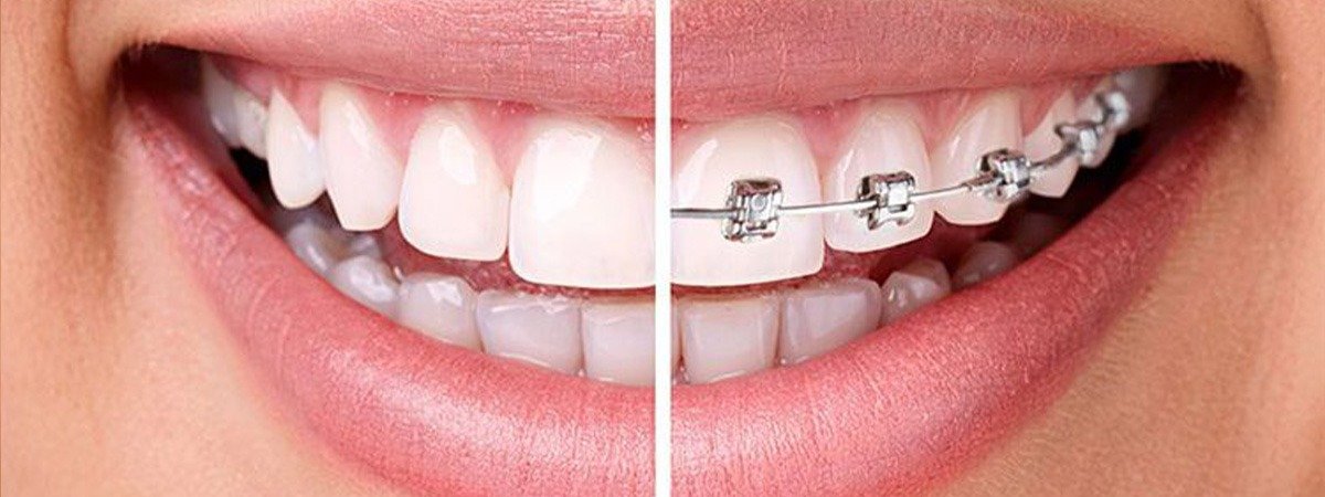 braces vs invisalign